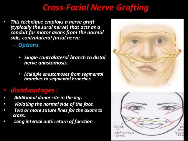 hypoglossal facial nerve anastomosis Escort service birmingham alabama
